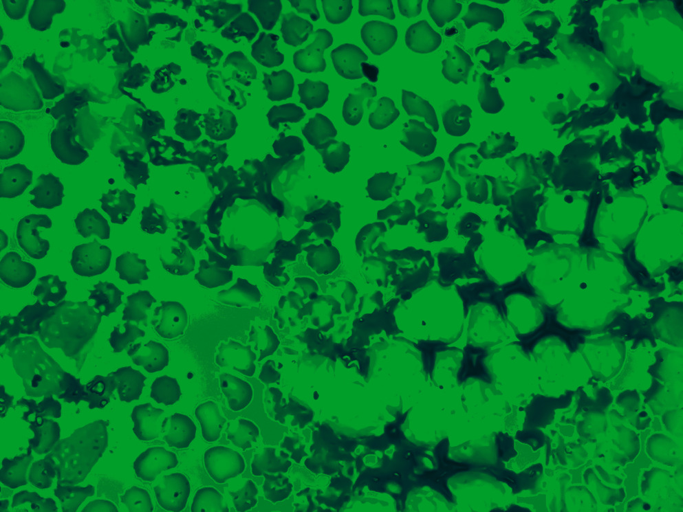 Bone marrow aspirate cytology of multiple myeloma, a type of bone marrow cancer of malignant plasma cells. 