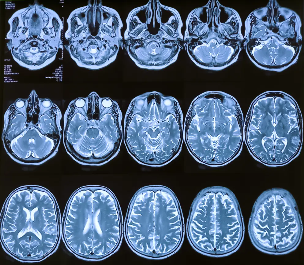 MRI scans showing multiple cross-sectional views of the human brain, highlighting cerebral cortical atrophy associated with relapsing multiple sclerosis. 