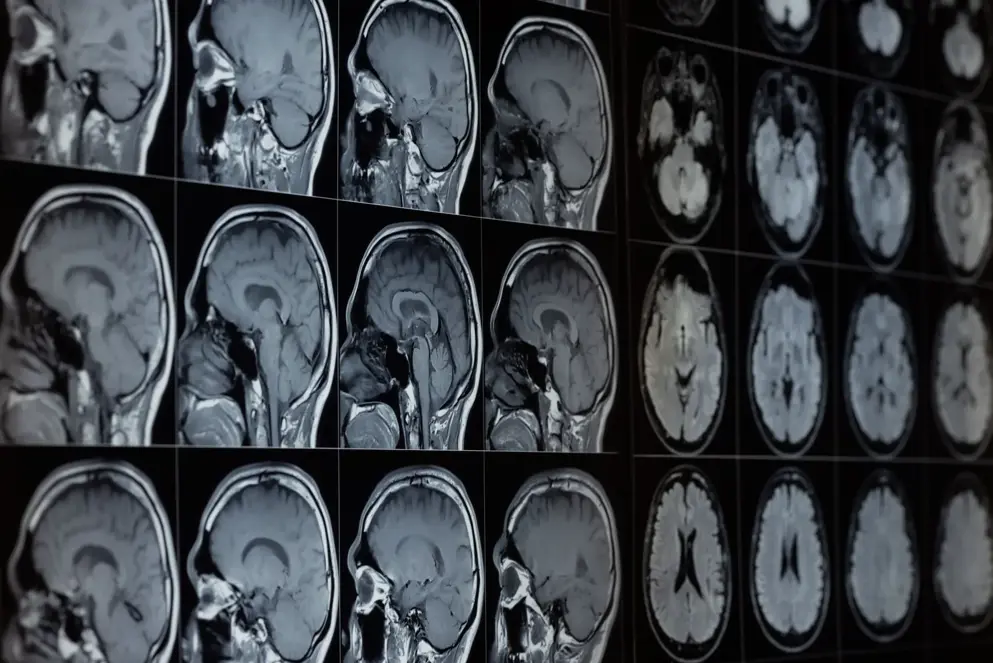 X-ray of a brain